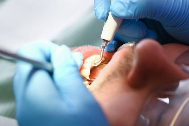 Best Emergency Dental Care for Broken or Chipped Teeth in Marks, MS
